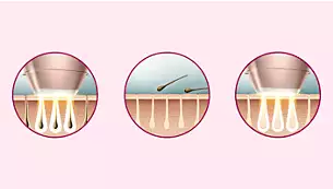 تقنية IPL المتطورة للاستخدام في المنزل، تم تطويرها بالتعاون مع أطباء الأمراض الجلدية